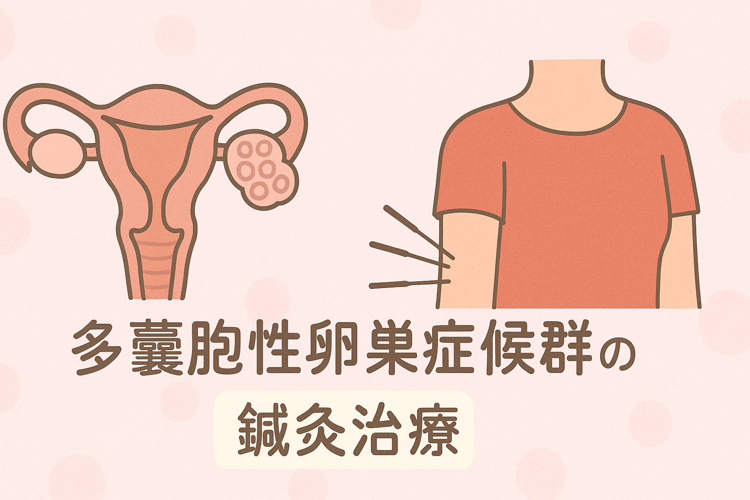多嚢胞性卵巣症候群の鍼灸治療