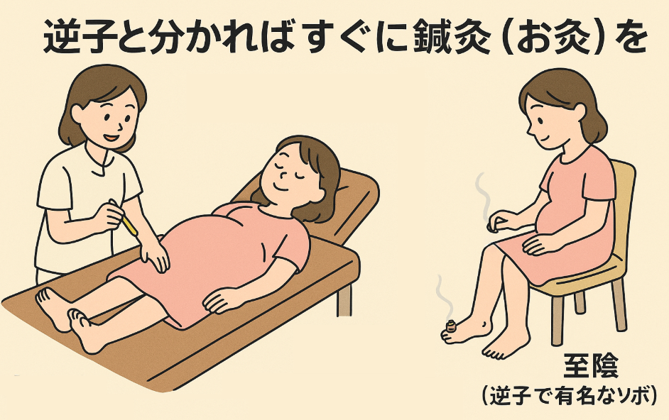 逆子と分かれば、すぐに鍼灸(お灸)を