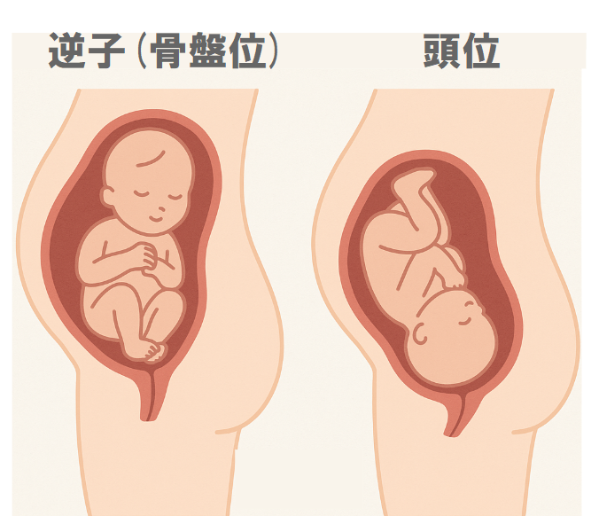 逆子(骨盤位)と頭位